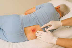 علائم عفونت زخم بستر