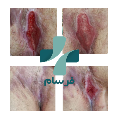 درمان زخم بستر در کرج