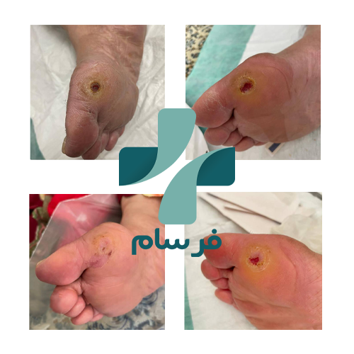 درمان قطعی زخم پای دیابتی در کرج