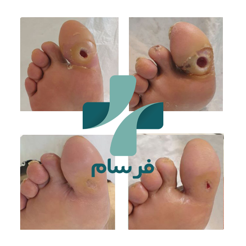 درمان زخم پای دیابتی در کرج