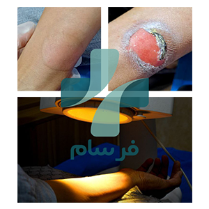 عکس زخم سوختگی