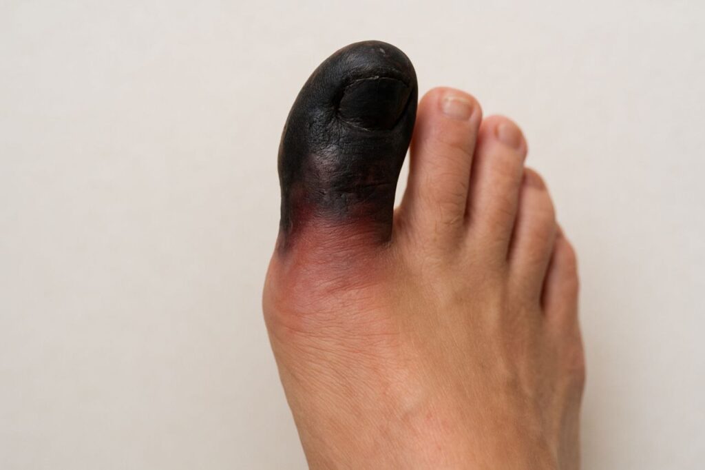 سیاه شدن انگشت پا دیابتی؛ راه نجات قبل از قطع عضو