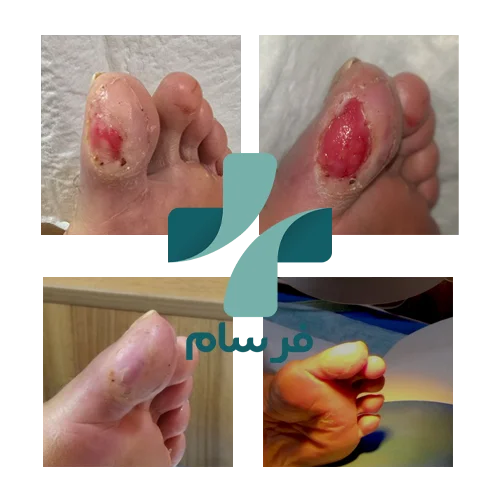 عکس زخم سوختگی