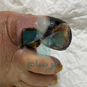 عکس سیاه شدن پای دیابتی