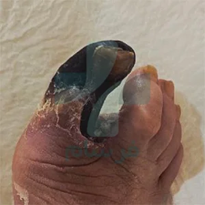 عکس سیاه شدن پای دیابتی