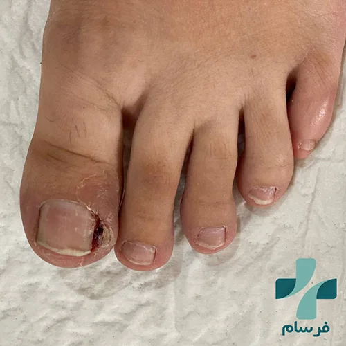 عکس ناخن فرو رفته در گوشت