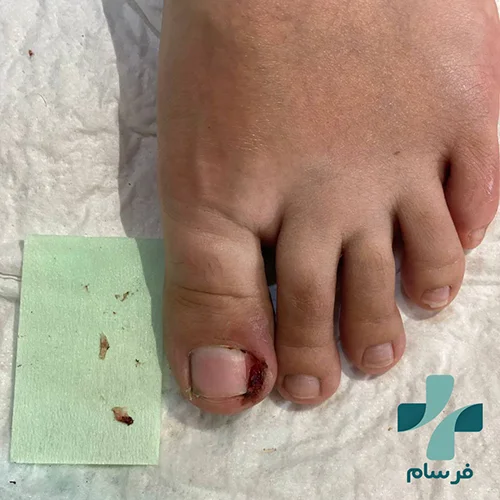 عکس ناخن فرو رفته در گوشت