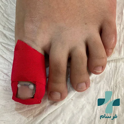 عکس ناخن فرو رفته در گوشت