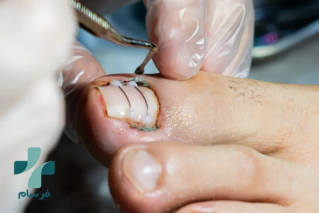 درمان ناخن فرو رفته در گوشت در کرج