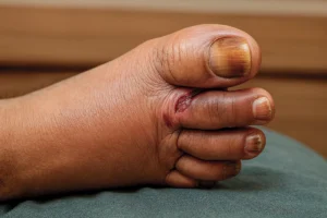 علائم عفونت زخم دیابتی