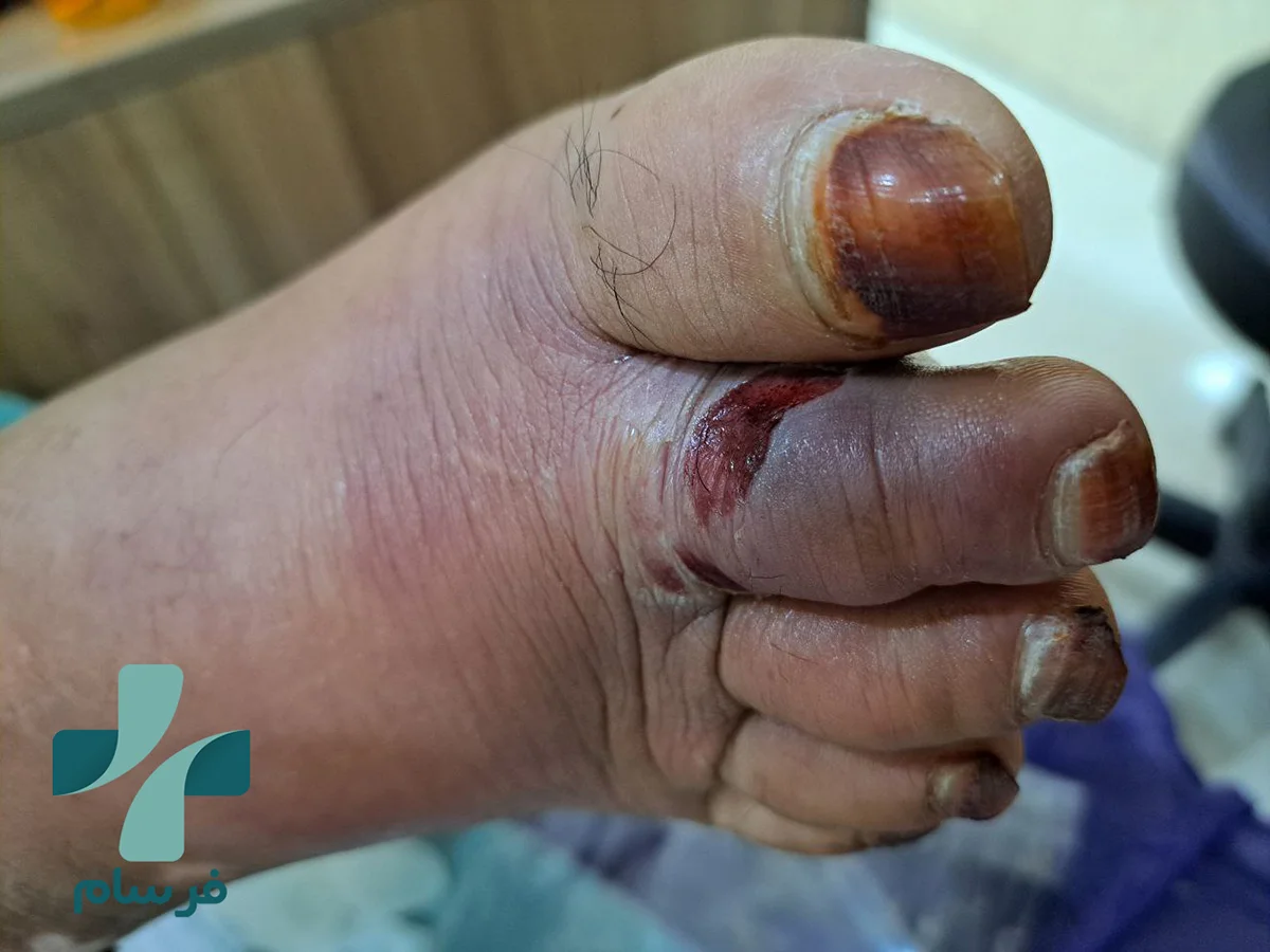 عفونت زخم دیابتی چیست؟