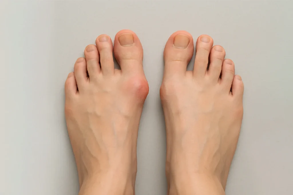 انحراف شست پا