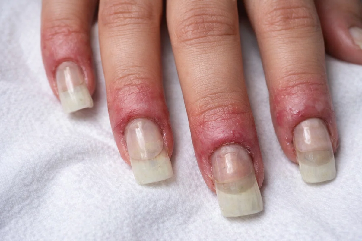 عوارض کاشت ناخن