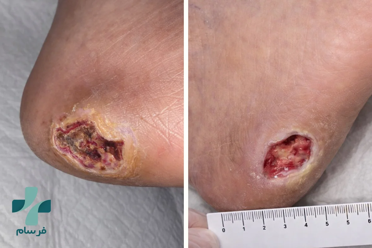 درمان زخم شریانی چگونه است؟