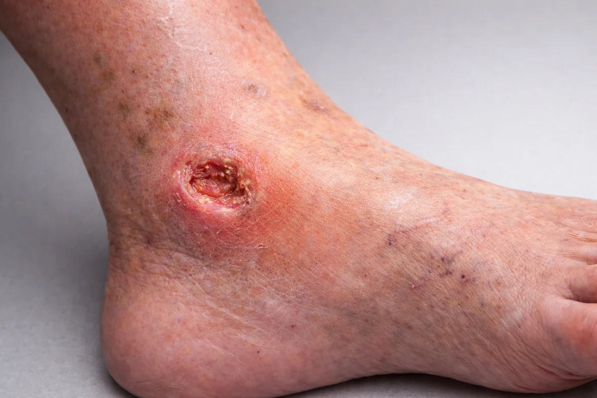 زخم وریدی پا چیست؟