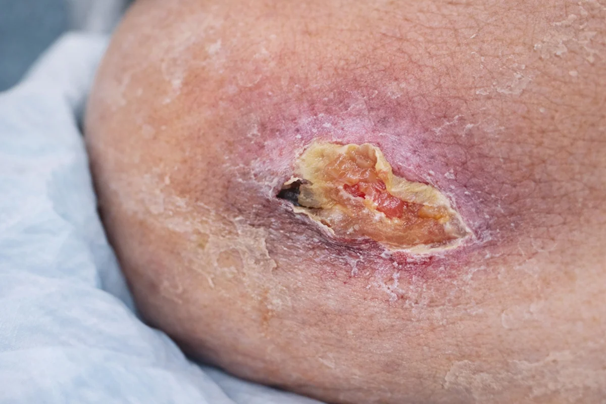 زخم فشاری (زخم بستر)