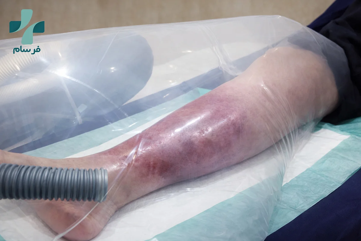 درمان زخم مزمن چگونه انجام می‌شود؟