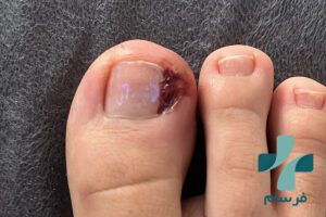 اهمیت درست کوتاه کردن ناخن